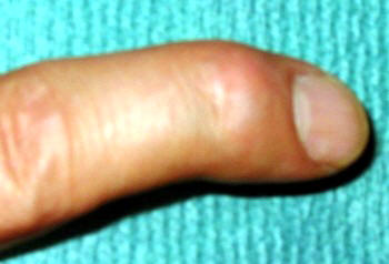 ticulación del dedo índice desviada hacia un lado y produciendo dolor