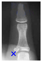 Radiografía del hueso fracturado tras un desgarre del tendón