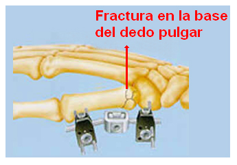 Fractura del dedo pulgar tratada con tensores