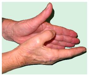 Fractura que afecta la mobilidad del pulgar