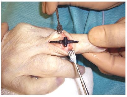 Implante en la articulación del dedo