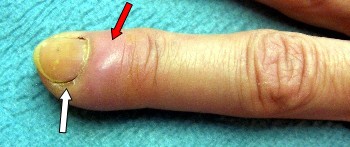 Infección en el dedo de la mano