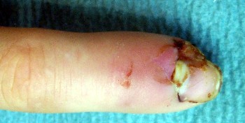 Infección originada por un herida en el costado de la uña