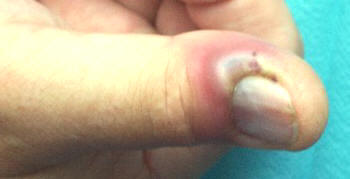 Burbuja de pus por infección en el dedo