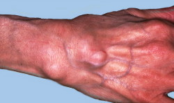 Fuerte reumatismo en la mano 
