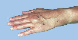 Reumatismo en la base del dedo medio
