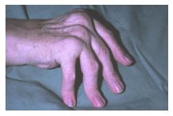 Síntomas de reuma en las articulaciones de los dedos de la mano
