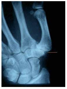 Radiografía de una artrosis