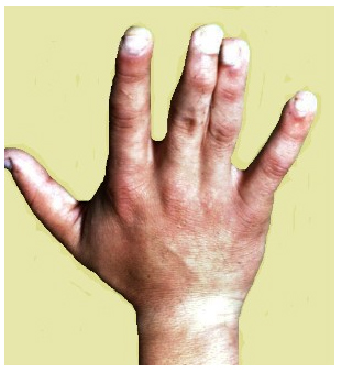 Tercer y cuarto dedo de la mano afectados por Syndaklie