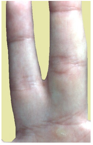 Huesos de la mano fusionados